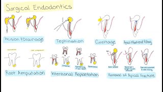 Surgical Endodontics [upl. by Lesde]