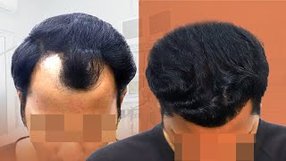 Natural Hairline Restoration New Roots the Leaders in Hair Transplants 😊 [upl. by Nuhsar]