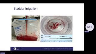 Continuous Bladder Irrigation [upl. by Moorish496]