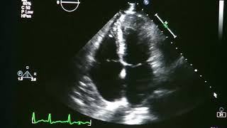 Atrial Fibrillation On Echocardiogram [upl. by Slaohcin]