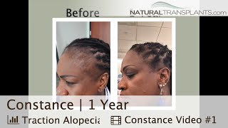 12 Months Hair Transplant Results For Traction Alopecia  Dr Siegel Constance [upl. by Lesnah]