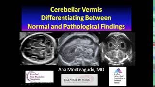 AIUM Webinar Cerebellar Vermis [upl. by Rosina392]