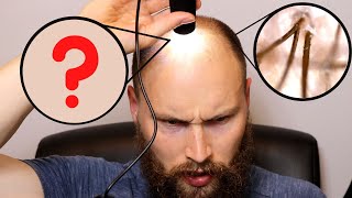 Balding Hair vs quotNormalquot Hair  Miniaturization In Male Pattern Baldness [upl. by Ahsinav]