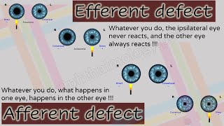 Pupil 2  Characteristics of Afferent and Efferent Pupillary Defects [upl. by Brost]