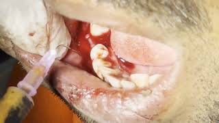 Explosive Dental abscess drainage and tooth extraction  Live On Patient [upl. by Rol811]