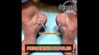 Piezogenic Pedal Papules [upl. by Earle968]