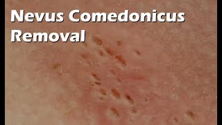 Nevus Comedonicus Removal  9 minutes worth [upl. by Henrietta551]