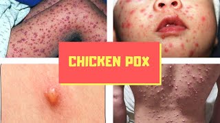 What is Chicken pox Pictures Signs and Symptoms of Chickenpox Virus Varicella [upl. by Philoo303]