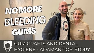 Gum Grafts and Dental Hygiene Adamantios Story [upl. by Cirala]