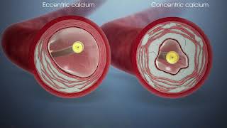 Shockwave Lithotripsy  Fortis Healthcare [upl. by Fabiano829]