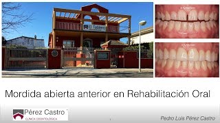 Mordida Abierta Anterior en Rehabilitación Oral [upl. by Voltz]