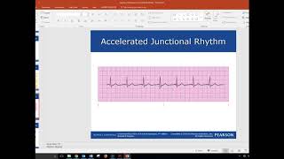 10 Second EKG Junctional Rhythm [upl. by Ahsekar]