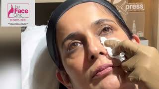 Profhilo Treatment Live  Dr Reema Arora  The Face Clinic  South Delhi [upl. by Drarreg]