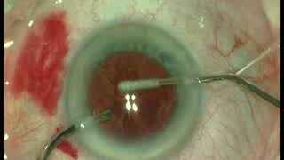 Parkinsons Head Tremor amp Phacoemulsification Cataract Surgery amp IOL Implant [upl. by Arriek]