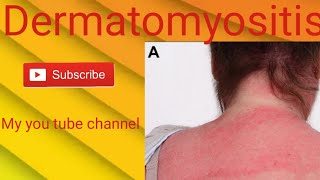 Skin disease Dermatomyositis clinical presentation [upl. by Hsivat]