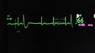 sinus rhythm with ventricular extrasystoles on an ECG heart monitor [upl. by Ardnazil]