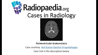 Periventricular leukomalacia Radiopaediaorg Cases in Radiology [upl. by Radec]