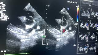 Complete AV Septal defect Double outlet RV severe Pulmonary stenosis Glen shunt [upl. by Beore72]