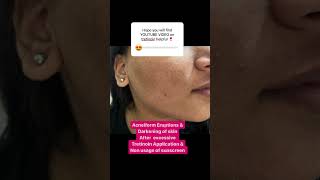 Tretinoin cream side effects  Acneiform Eruptions  Pigmentation of skin  Dr Ashima Goel MD [upl. by Merow124]