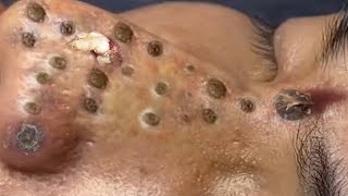 Removal blackheads and whitehead extraction 23 [upl. by Fulbright]