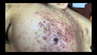 ACNE TREATMENT FOR Mạnh past 2 45  Loan Nguyen [upl. by Dania]