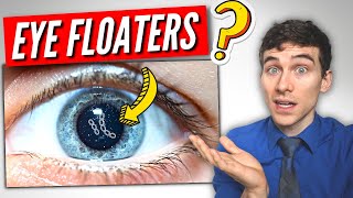 3 Must Know Facts About EYE Floaters [upl. by Alton]