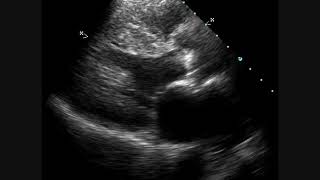 Calcific Aortic Stenosis  Echocardiogram [upl. by Ydnirb]