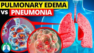 Pulmonary Edema vs Pneumonia [upl. by Anitsrik]