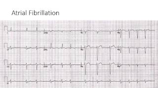 Atrial Fibrillation [upl. by Servais]