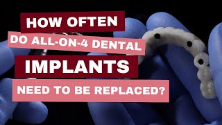 How Often Do Allon4 Dental Implants Need to Be Replaced  Dr Nawrocki Explains [upl. by Michelina]