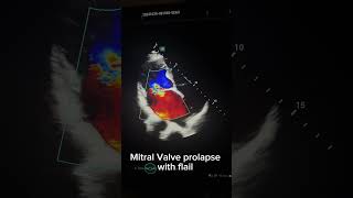 Mitral regurgitation echocardiography echocardiographer itral regurgitation [upl. by Nahem]