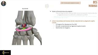 Imagerie des pathologies du DCSS [upl. by Broder]