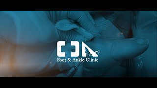 Minimally Invasive Hallux Rigidus Surgery [upl. by Llenrahs]