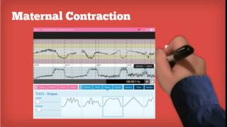 Midwifery Simulation ctg iSimulate [upl. by Tlevesor30]