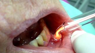 Canker Sores treatment Ozone DTA [upl. by Llehcam]