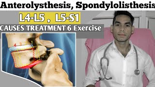 Anterolisthesis spondylolisthesis L5s1 spondylolisthesis Treatment Exercise Low back pain [upl. by Notgnilliw909]