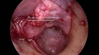 Middle ear glue with edematous mucosa [upl. by Lejeune]