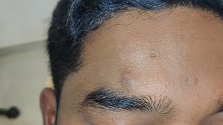 Sebaceous cyst removal mybracesdentalclinic3511 [upl. by Dwight]