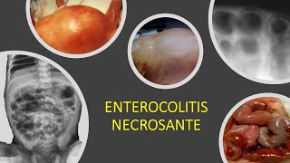 Enterocolitis necrosante [upl. by Essile]