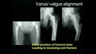 Biomechanics of the Hip Joint [upl. by Annahahs101]