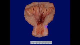 Pathology  dr Nafeaa  Neoplasia كل ما تريد عن الأورام [upl. by Ayna]