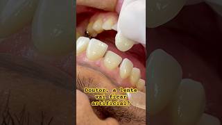 Lente de contato ou dente odontologia dentista sorriso lentedecontatodental [upl. by Ennylcaj]