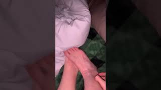 nail foot eczema scratching asmr [upl. by Barbuto]