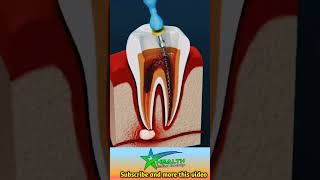 Root Canal Treatment amp Tooth Abscess [upl. by Macintosh]