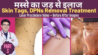 Skin Tags Removal Treatment  DPN Removal Treatment  मस्सो का इलाज  CO2 Laser treatment [upl. by Nodnas]