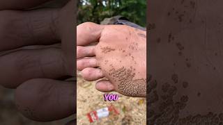 Weird Foot Skin Disease 🤢 [upl. by June750]