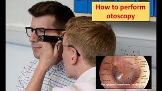 How to perform Otoscopy Ear Exam [upl. by Analise]