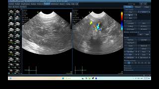 IQ 261 BILATERAL KIDNEY ULTRASOUND ECHOPACX ANALYSIS [upl. by Arikihs617]