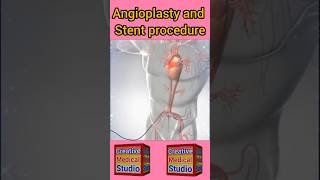 Angioplasty technique  Stent and Angioplasty procedure shorts [upl. by Wittie]