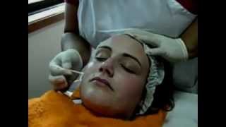 VÍDEO PEELING QUÍMICO IIwmv [upl. by Anitsuga]